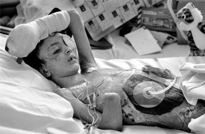 The mission to save Saleh brought him and his father to Children's Hospital Oakland, leaving his pregnant mother and two younger sisters behind in Iraq. The explosion had ripped open Saleh's abdomen, torn off his right hand and most fingers on his left, blown out his left eye and killed his older brother.